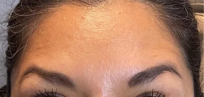 Paket – Silikonski flasteri protiv bora – OČi + Čelо