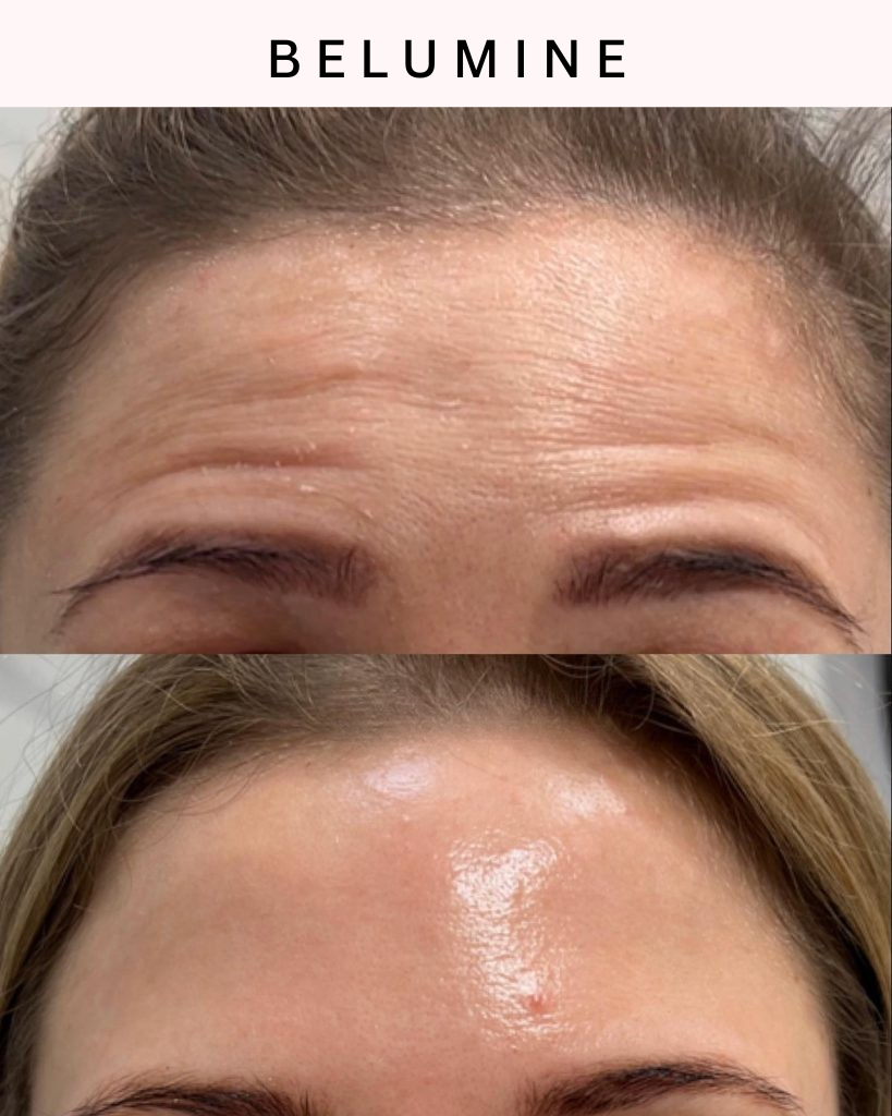 Silikonski flaster za bore na čelu