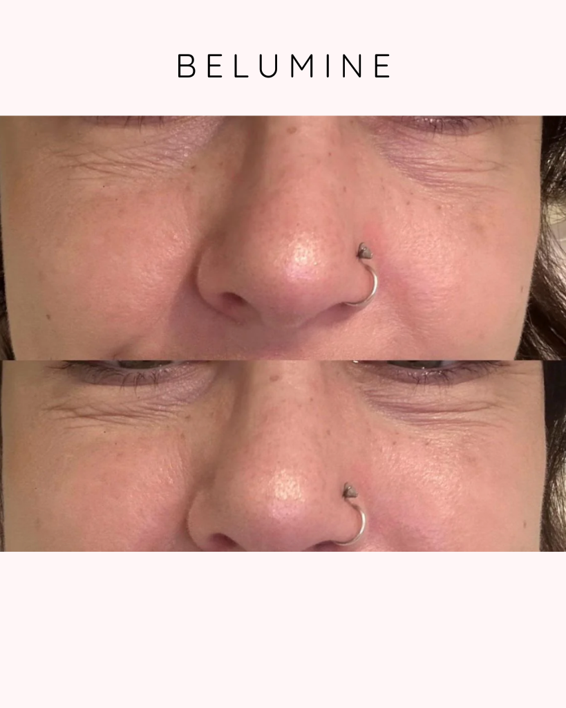 Paket – Silikonski flasteri protiv bora – OČi + Čelо