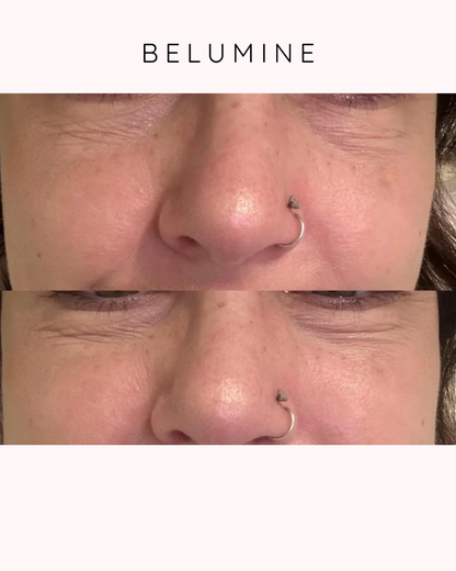 Paket – Silikonski flasteri protiv bora – OČi + Čelо