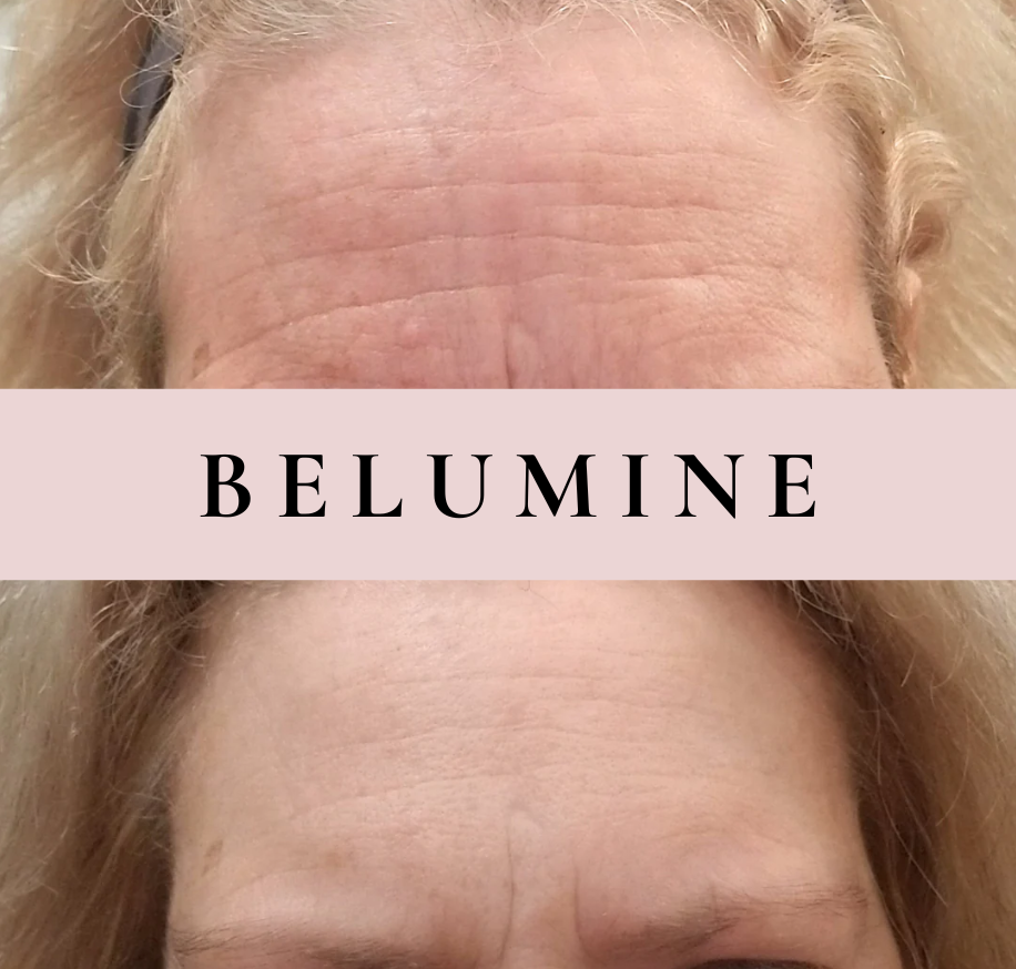 Silikonski flaster za bore na čelu