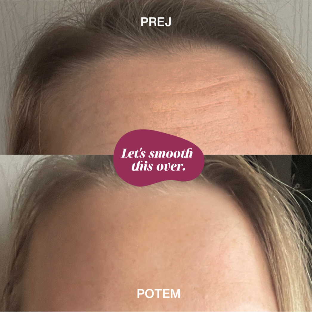 Silikonski flaster za bore na čelu