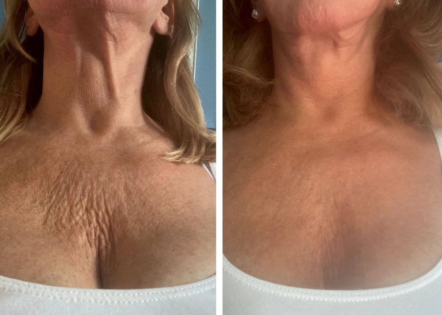 Silikonski flaster protiv bora na prsima