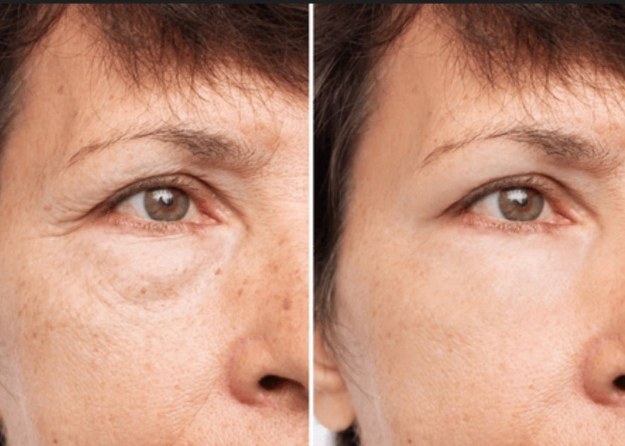 Paket – Silikonski flasteri protiv bora – OČi + Čelо